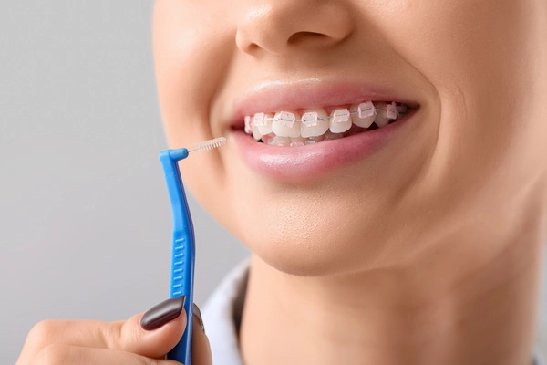 Proper Care Tips For Your Clear Braces
