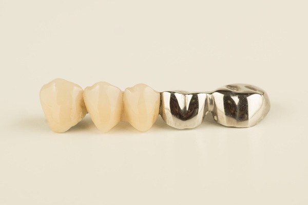 When Should You Choose A Dental Bridge Over An Implant?