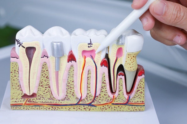 Why Root Canals Are Not As Scary As People Think